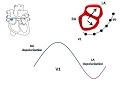 ECG course: Atrial Enlargement, Dr. Sherif Altoukhy