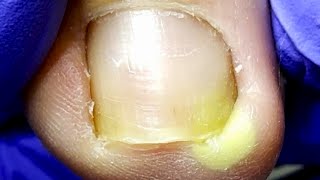 A Small Ingrown Toenail Hurts The Toe! Treatment[Doctor Liu Pedicure]