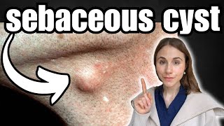 The Only Way To Remove A Sebaceous Cyst