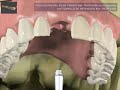 ¿como se hace la prótesis sobre implantes dentales