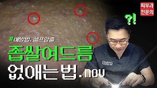 피부 요철, 좁쌀 여드름 (면포) 없애는 방법! - 셀프 압출, 홈케어, 예방 관리  | 피부과전문의 닥터창