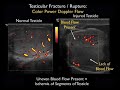 bedside ultrasound in a case of blunt scrotal trauma 2