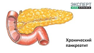 Хронический панкреатит: причины, симптомы, лечение