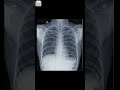 Normal lung vs Infected lungs 🫁 #lungs #chest #radiology #xray #neet #radiology #medicos #doctor