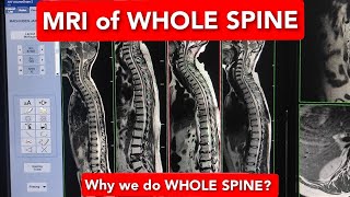 MRI WHOLE SPINE | Why we do MRI Whole Spine?