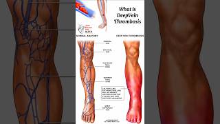 What is Deep Vein Thrombosis #medical #animation #3d #short | learn Biology with Aliya