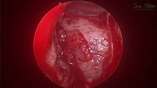 Brain herniating into nose - Meningoencephalocele posterior table frontal sinus.