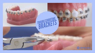 Brackets SOS! - Was tun wenn der Draht piekst? - Druckstelle an den Brackets