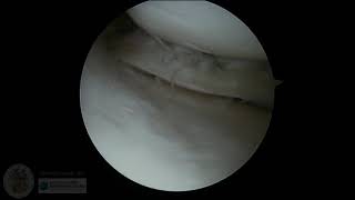 Complex Medial Meniscus Tear: vertical/bucket handle and deep horizontal cleavage components