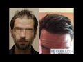 dr.erkan demirsoy 3188 grafts fue before after photos