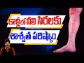 కాళ్లలో నీలి సిరలకు శాశ్వత పరిష్కారం| Cure for Varicose Veins| Home Remedies to Treat Varicose Veins