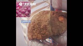 Жигар циррози ва уйқусизлик қандай боғлиқ?. #inmedicina #shorts  #gipertonia #hypertone #cirrhosis