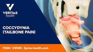 Coccydynia (Tailbone Pain)