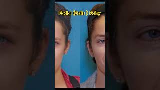 முக வாதம் எப்படி இருக்கும்?#neurology #neuroscience #bellspalsy