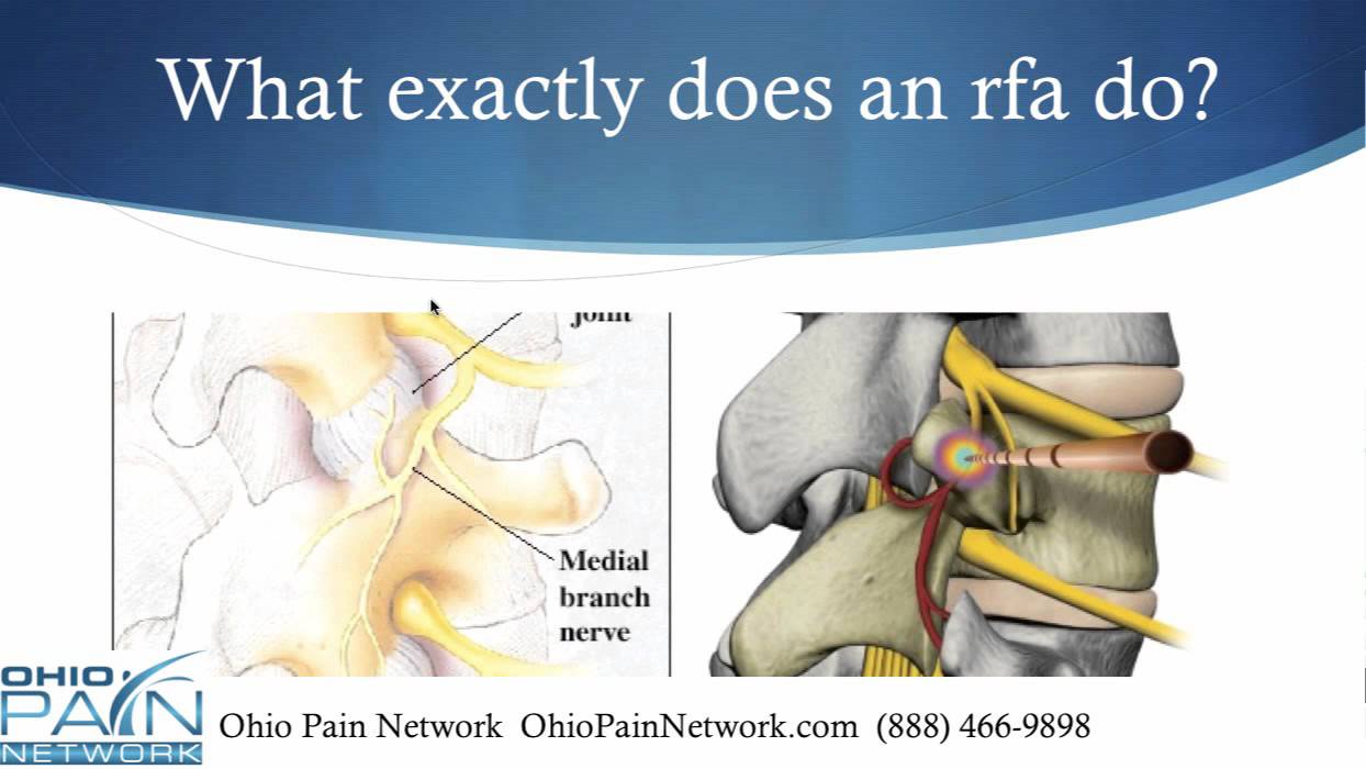 Basics Of Radiofrequency Ablation For Neck/Back Pain In Ohio - YouTube