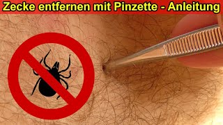 Zecke entfernen mit Pinzette \u0026 ohne Zange Anleitung / Zecken rausmachen beim Mensch ohne Zeckenzange