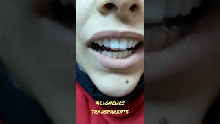 Les aligneurs transparents une revolution dans le monde de l'orthodontie