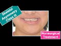 Nonsurgical treatment of skeletal asymmetrical Class III Malocclusion｜【Chris Chang Ortho】CC716