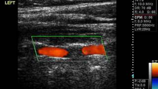 VERTEBRAL ARTERIES DOPPLER ultrasound.wmv