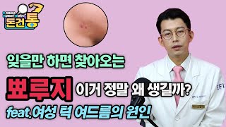 Why do I keep getting Zits? Pimples on Chin Explained 잊을만 하면 찾아오는 뾰루지! 생기는 이유와 예방 feat.여성 턱 여드름의 원인