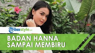 Terungkap Kondisi Hanna Kirana sebelum Dilarikan ke Rumah Sakit, Badan sampai Biru-biru