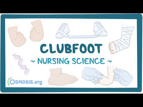 What is talipes equinovarus in medical terms?