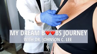 Breast Lift without Implants: My Story | Dr. Johnson C. Lee | Beverly Hills, CA