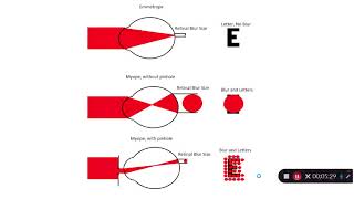 Visual Acuity in Refraction and Refractive Error