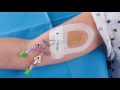 Tegaderm™ CHG (1657) - Application & Removal for PICCs