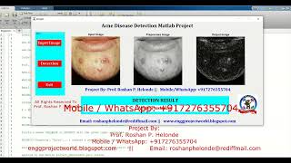 Acne Disease Detection Using Image Processing With Source Code Acne Disease Detection Using Matlab