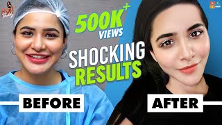 V Shape Face Lift || Shocking Results || Face Care || Ashu Reddy