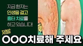 핀홀셀레이저 치료는 이렇게 해야 흉터제거가 됩니다(Feat.피부이식흉터)