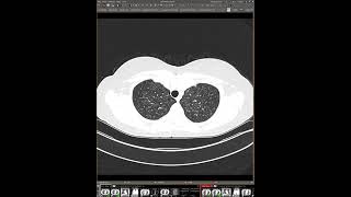 STR Cardiothoracic Case Webinar 4/18/2024