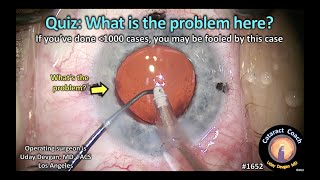 CataractCoach 1652: Cataract Quiz: What is the problem here?