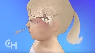 Endoscopic Neurosurgery for Brain Tumors in Children