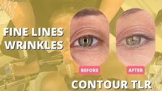 CONTOUR TLR ERASES FINE LINES AND WRINKLES | Dr. Jason Emer