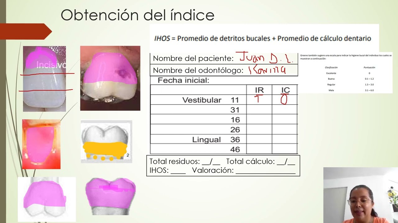 Indice De Higiene Oral Simplificado - YouTube