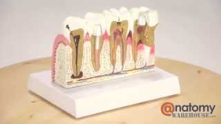 Diseased Teeth And Gums Anatomy Model by AnatomyWarehouse.com