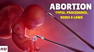 Abortion: Everything You Need To Know & What To Expect
