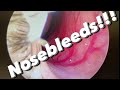 Nosebleeds (epistaxis):  causes, prevention, treatments, and more