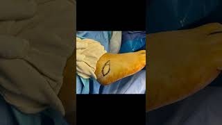 DESYNDACTYLIZATION SURGERY 💉Graphic Content‼️#shorts