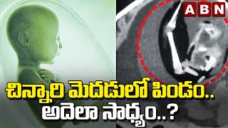 చిన్నారి మెదడులో పిండం.. అదెలా సాధ్యం? | 'parasitic Unborn Twin' Found In 1-year-old's Brain | ABN