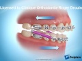 correction de malocclusion avec ressorts