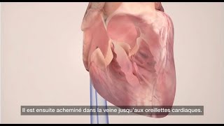 La fibrillation atriale  : Ablation par Cathéter