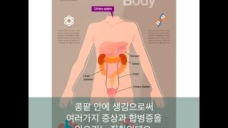 신장결석을 유발하는 음식