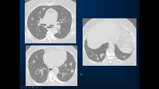 Outpatient Treatment of ANCA associated Pulmonary Vasculitis