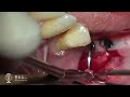 Augment Keratinized Tissue Around Implants Without Palatal Donor Site I