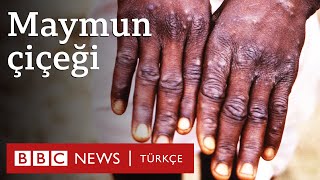 Maymun çiçeği virüsü: \