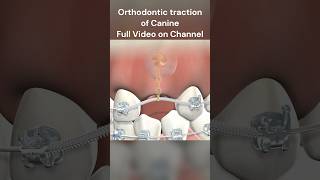 Exposure of Impacted Canine #shorts #orthodontics #braces #dentist #bds #neetmds #teeth #easy