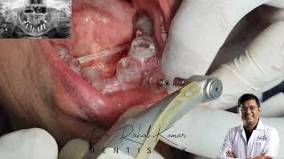 Full mouth Implant without any pain in a single day only in 1 hours using latest technology..